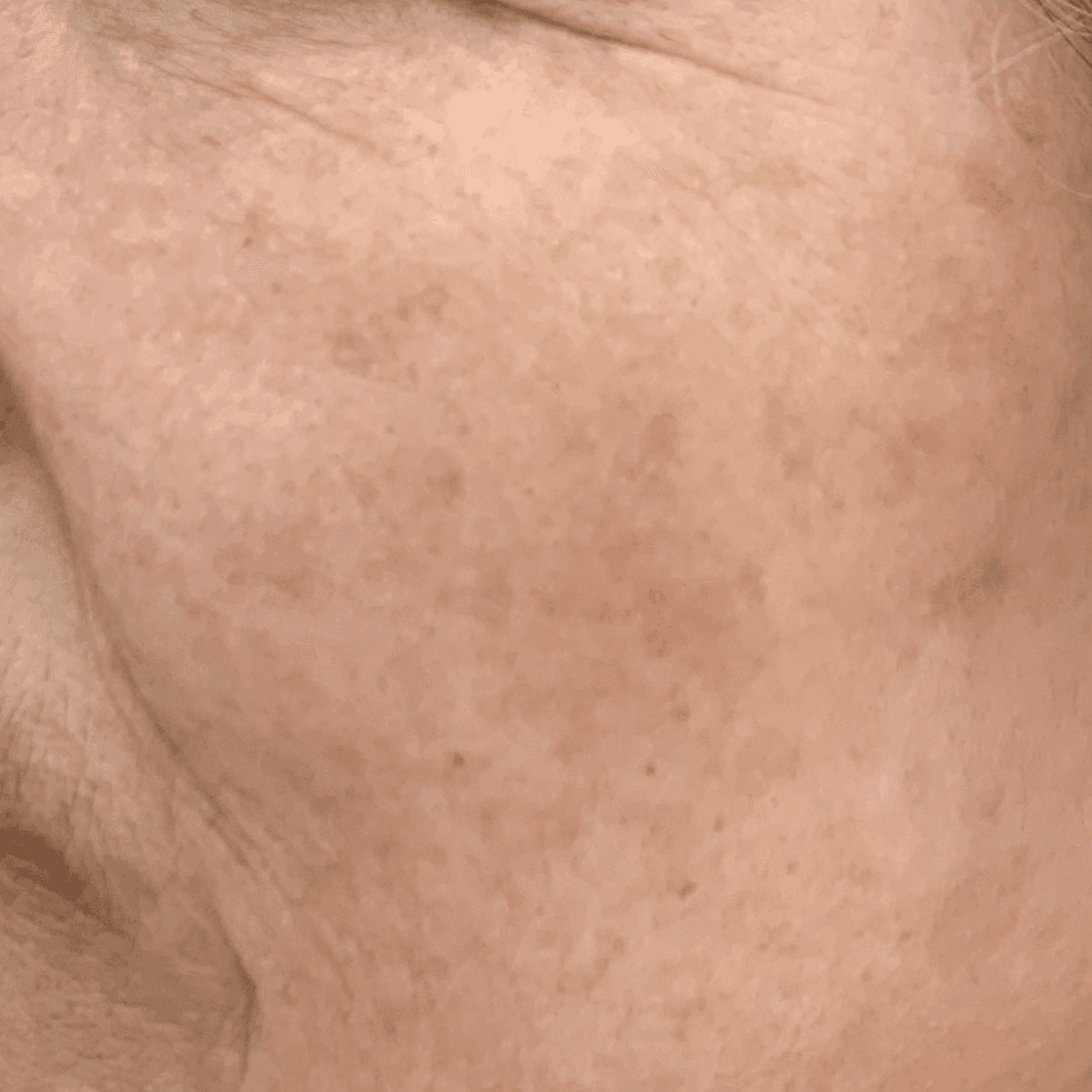 케어 사례 1 after