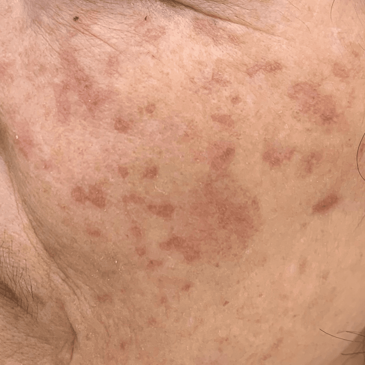 케어 사례 1 before