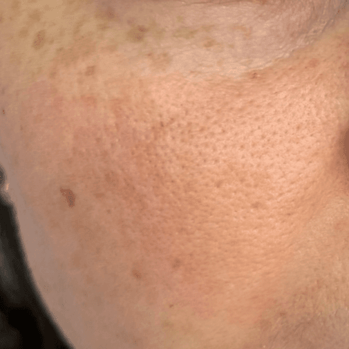 케어 사례 2 before