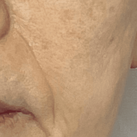 케어 사례 3 after