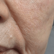 케어 사례 3 before